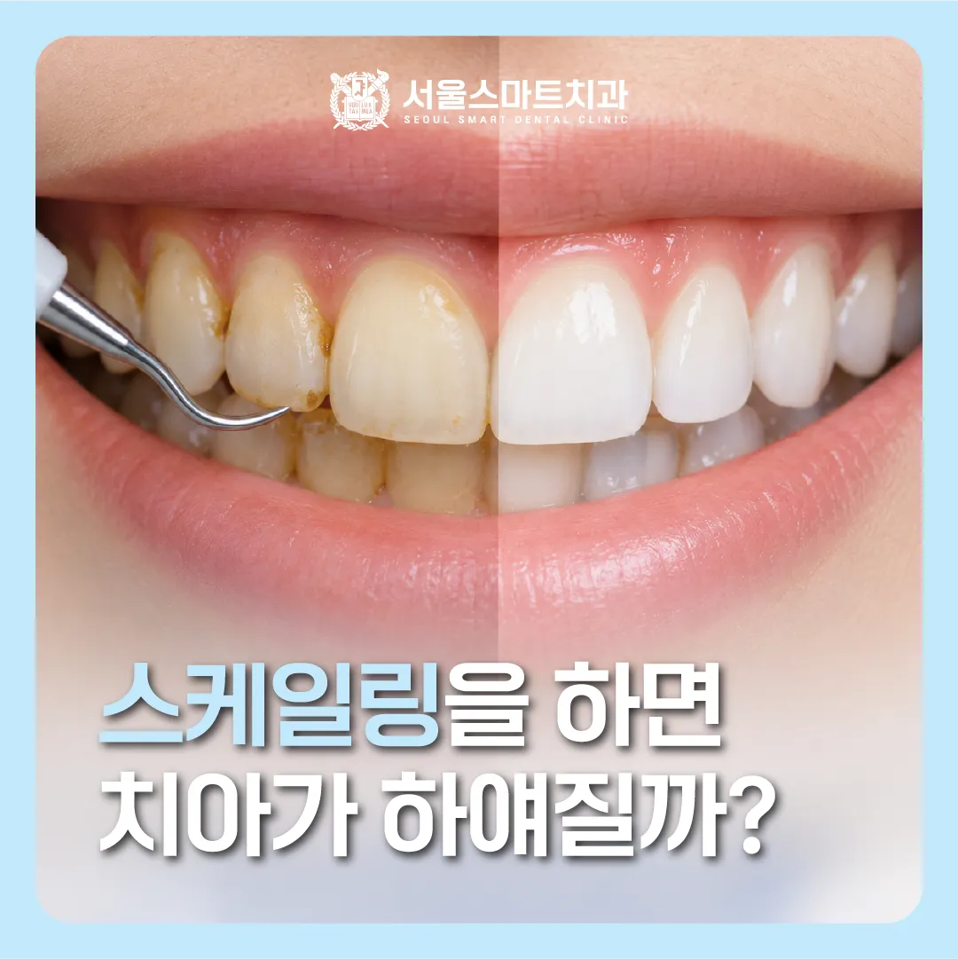 스케일링을 하면 치아가 하얘질까요?